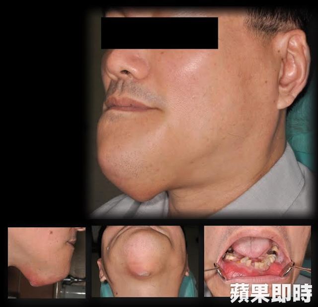 高雄醫學大學秘書處 摘腫瘤移植小腿骨重建帥氣下巴 高醫口腔外科醫師許瀚仁受訪 系列報導